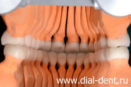 Restaurare estetică de coroane dentare ceramice