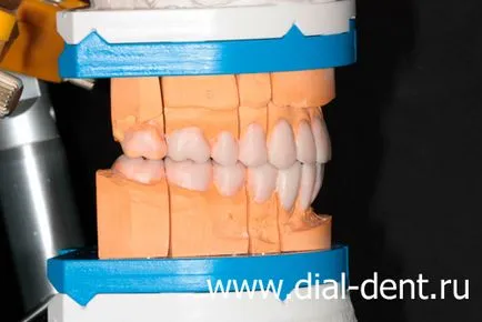 Естетична възстановяване на керамични зъбни коронки