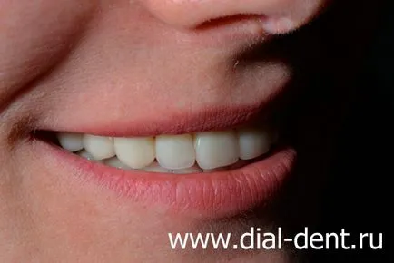 Restaurare estetică de coroane dentare ceramice