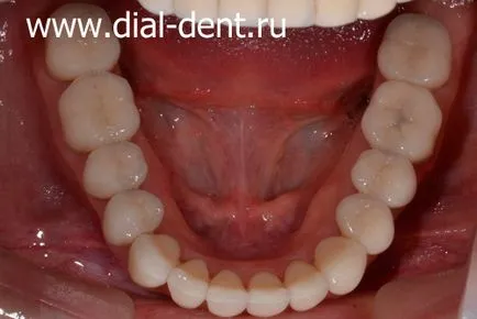 Restaurare estetică de coroane dentare ceramice