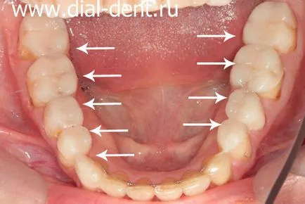 Restaurare estetică de coroane dentare ceramice