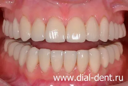 Restaurare estetică de coroane dentare ceramice