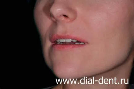 Restaurare estetică de coroane dentare ceramice