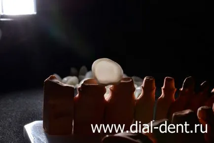 Restaurare estetică de coroane dentare ceramice