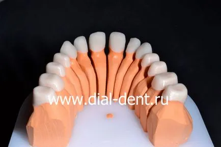 Restaurare estetică de coroane dentare ceramice