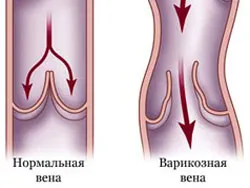 Phlebopathy duzzanat és nehéznek a lábak