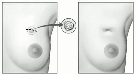 Fibroadenoma a mell távolítani vagy sem