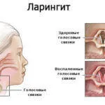 Inflamația corzilor vocale, simptome, tratament