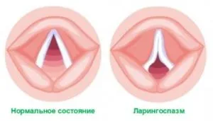 Възпалението на гласните струни, симптоми, лечение