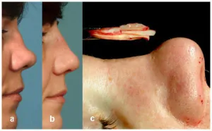 Implanturile în nas pentru rinoplastie
