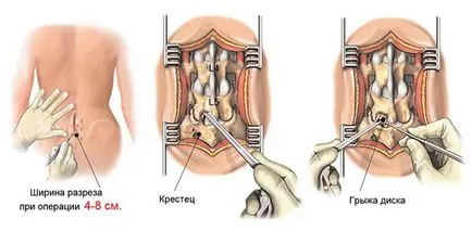 Hernia de discuri intervertebrale - tipurile și metodele de tratament