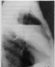 Diagnosticul instrumental și diferențial al bolii pulmonare supurative