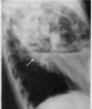 Diagnosticul instrumental și diferențial al bolii pulmonare supurative