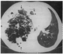 Diagnosticul instrumental și diferențial al bolii pulmonare supurative