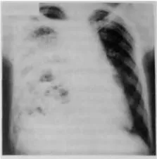 Diagnosticul instrumental și diferențial al bolii pulmonare supurative