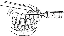 Metode de injectie de anestezie - stomatologie, anestezie si anestezie generala in stomatologie si chirurgie maxilo-facială -