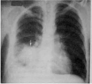 Diagnosticul instrumental și diferențial al bolii pulmonare supurative