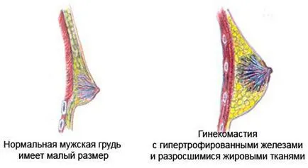 Вярно гинекомастия при мъжете и лечение на симптомите