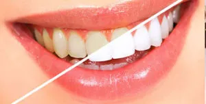 Hogyan fehéríti a fogakat a gyors - 9 egyszerű módszer