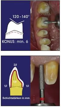 Dental-revü, cikkek, ortopédiai, különösen a készítmény a fogak mesterséges koronák