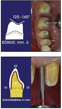 Dental-revue, articole ortopedice, în special pregătirea dinților sub coroane artificiale cu