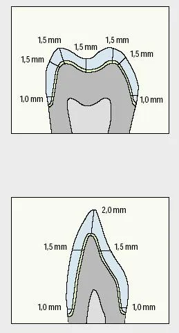 Dental-revue, articole ortopedice, în special pregătirea dinților sub coroane artificiale cu