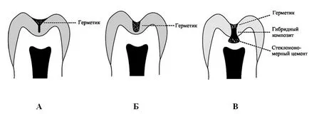 Dental-revue, articole, carii dentare terapeutice sclerotice