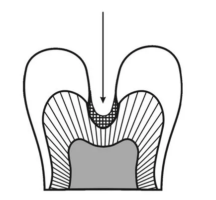 Dental-revü, cikkek, gyógyászati, fogszuvasodás scleroticus