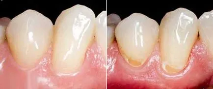 Cariile dentare cauze de cariilor dentare la adulți și copii