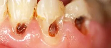 A fogszuvasodás okozza a fogszuvasodást a felnőttek és a gyerekek