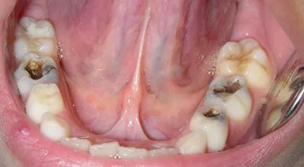 A fogszuvasodás okozza a fogszuvasodást a felnőttek és a gyerekek