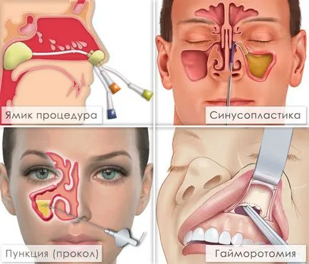 Циститна синузит симптоми и лечение, е