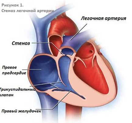 stenoza pulmonară valvulară în nou-născutului