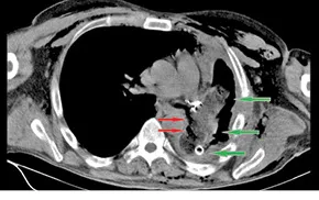 Лечение postpneumectomic бронхиална фистула в гръдната онкологичен преглед литература и