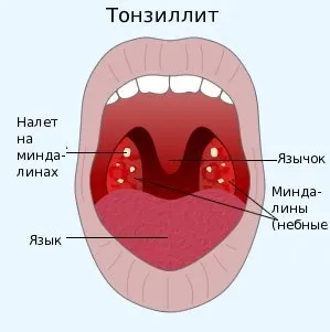 Tratamentul amigdalite la Moscova - gratuit de consultare medic on-line