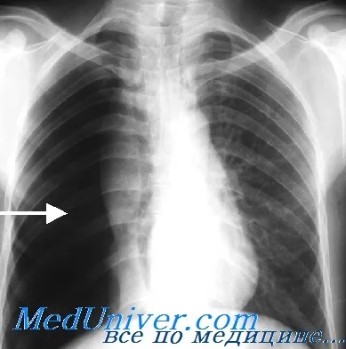 Tratamentul pneumotorax traumatic