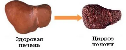 Лечение на чернодробна цироза видове, лекарства, прогноза