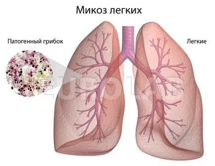 Tratamentul infecției fungice pulmonare - portalul medical EUROLAB