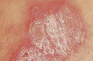 Diagnózis és kezelés a pikkelysömör, a psoriasis kezelésére