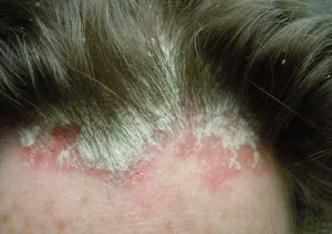 Diagnózis és kezelés a pikkelysömör, a psoriasis kezelésére