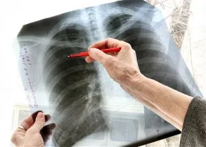 Differenciáldiagnosztikája bronchitis és a tuberkulózis