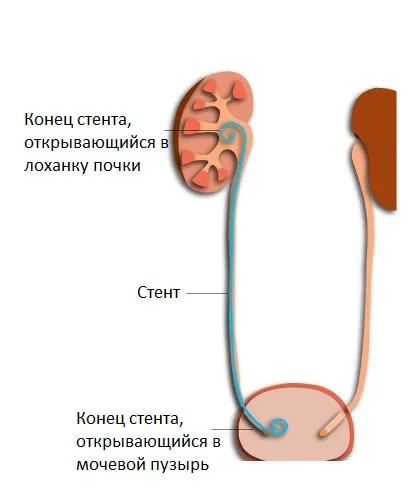 Diagnosticul și tratamentul hidronefroza - atunci când este necesară operația