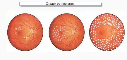 Diabetici Tipuri retinopatie, simptome și tratament