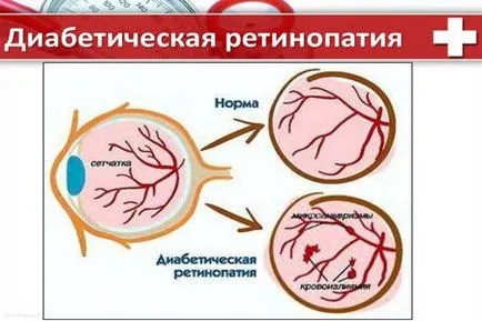 Диабетна ретинопатия симптоми, етапа на третиране и болест