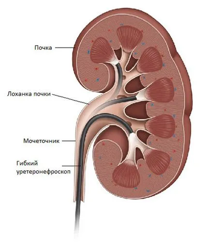 Diagnosticul și tratamentul hidronefroza - atunci când este necesară operația