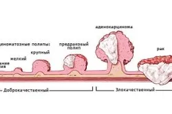 Leiomyoma a gyomor tünetek és a kezelés, a tünetek, prognózis (fotó és videó)