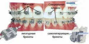 лигатура тиранти