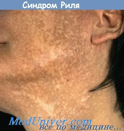 Melasma токсичен ретикуларната - клинична картина, диагностика, лечение