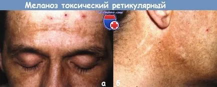 Melasma reticulară toxică - tablou clinic, diagnostic, tratament