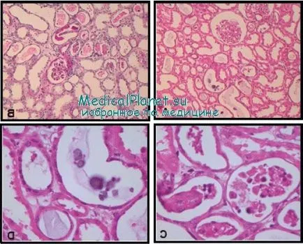 Myoglobinuria gyermeket okok, diagnózis, kezelés